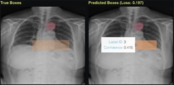 Hydrogen Torch chest X-ray